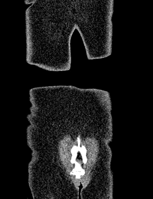 Bilateral staghorn calculi (Radiopaedia 59475-66842 Coronal non-contrast 95).jpg