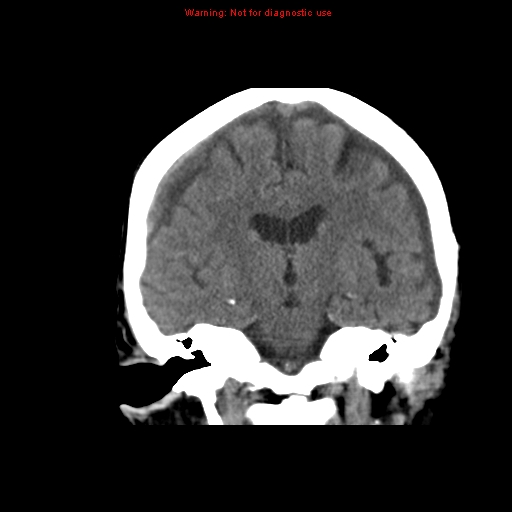 File:Bilateral subdural hemorrhage (Radiopaedia 8819-9620 Coronal non-contrast 7).jpg