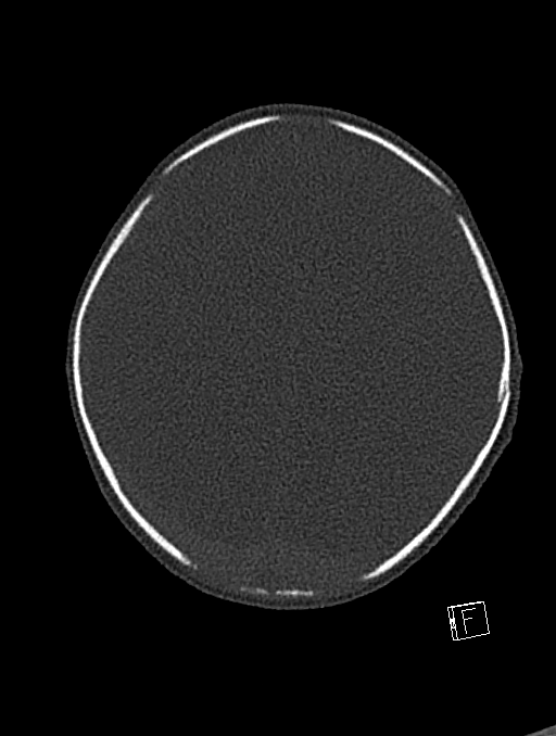Bilateral subdural hemorrhage and parietal skull fracture (Radiopaedia 26058-26192 Axial bone window 35).png