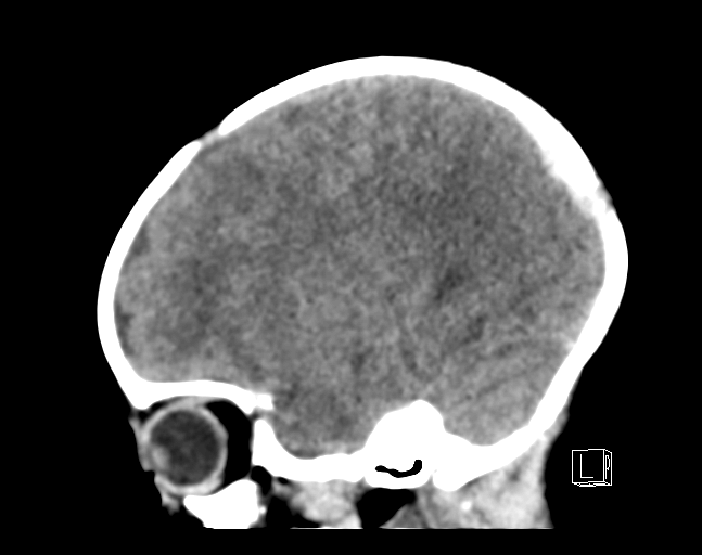 File:Bilateral subdural hemorrhage and parietal skull fracture (Radiopaedia 26058-26192 C 7).png