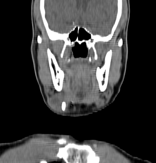 Bilateral submandibular sialolithiasis with sialadenitis (Radiopaedia 70721-80881 Coronal non-contrast 17).jpg