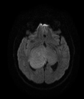 File:Bilateral thalamic gliomata (Radiopaedia 42538-45664 Axial DWI 11).jpg