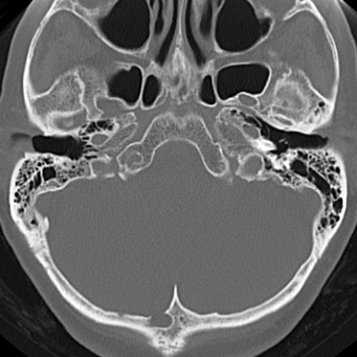 File:Bilateral tympanoplasty (Radiopaedia 16947-16664 Axial bone window 18).jpg