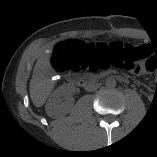 Bile leak from liver traumatic laceration (Radiopaedia 63463-72077 Axial Biliscopin 69).jpg
