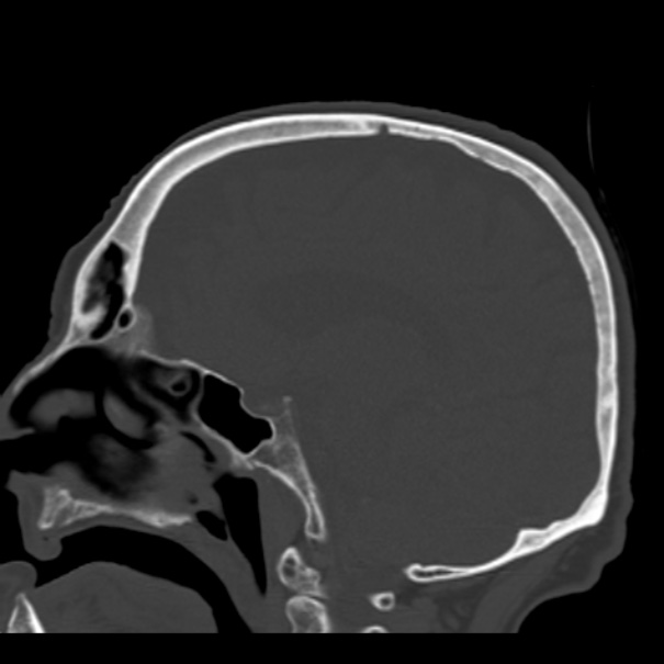 Biparietal osteodystrophy (Radiopaedia 46109-50463 Sagittal bone window 59).jpg