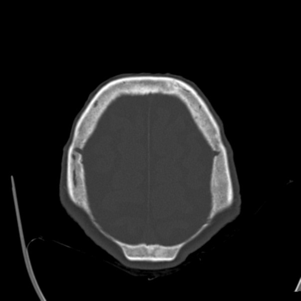Biparietal osteodystrophy (Radiopaedia 46109-50463 bone window 55).jpg