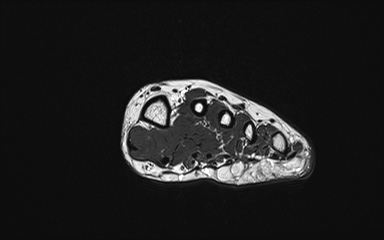 Bipartite hallux sesamoid diastasis (Radiopaedia 77133-89109 Coronal PD 17).jpg