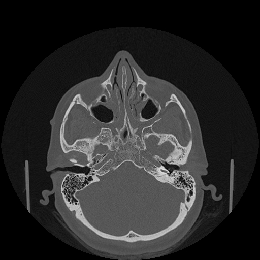 File:Bisphosphonate-related osteonecrosis of the jaw (Radiopaedia 71324-81642 Axial bone window 160).jpg