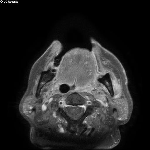 File:Bisphosphonate-related osteonecrosis of the maxilla (Radiopaedia 51367-57101 Axial T1 C+ fat sat 9).jpg