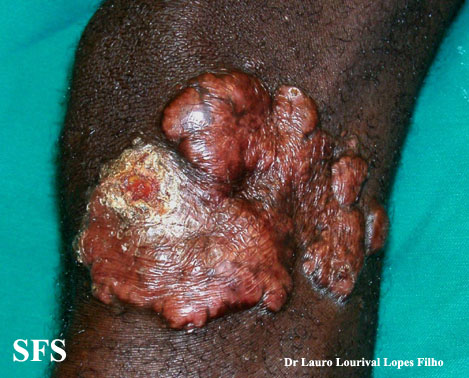 Blastomycosis-Keloidal Blastomycosis (Dermatology Atlas 2).jpg
