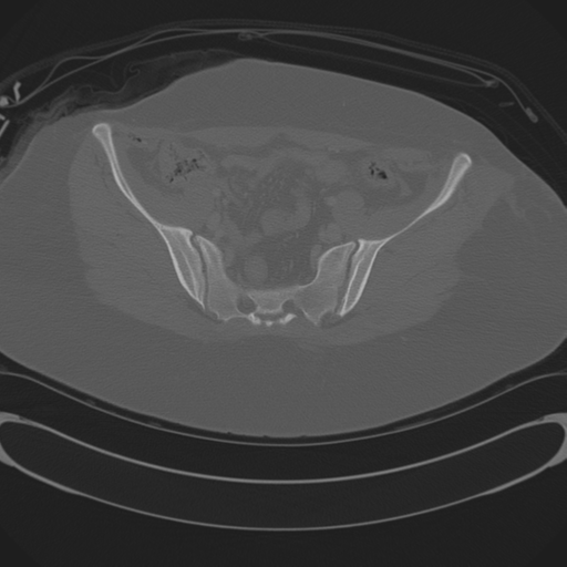 Blood in uterovesical and rectovesical pouch in trauma patient (Radiopaedia 34090-35340 Axial bone window 57).png