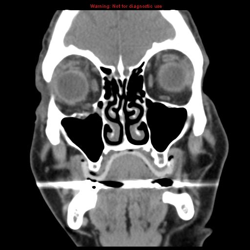 File:Blowout fracture with inferior rectus entrapment (Radiopaedia 12418-12673 Coronal non-contrast 8).jpg