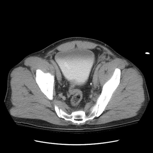 Blunt abdominal trauma with solid organ and musculoskelatal injury with active extravasation (Radiopaedia 68364-77895 Axial C+ delayed 118).jpg
