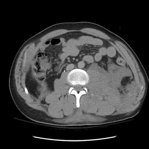 Blunt abdominal trauma with solid organ and musculoskelatal injury with active extravasation (Radiopaedia 68364-77895 Axial C+ delayed 72).jpg