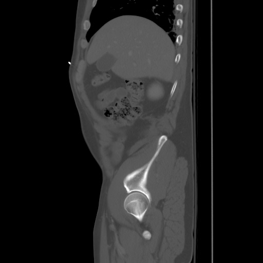Blunt abdominal trauma with solid organ and musculoskelatal injury with active extravasation (Radiopaedia 68364-77895 Sagittal bone window 15).jpg