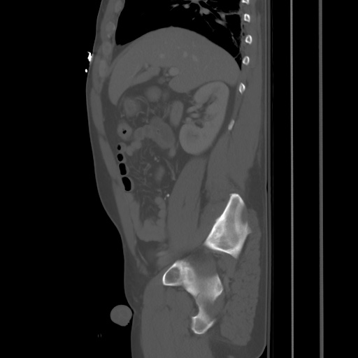 Blunt abdominal trauma with solid organ and musculoskelatal injury with active extravasation (Radiopaedia 68364-77895 Sagittal bone window 30).jpg
