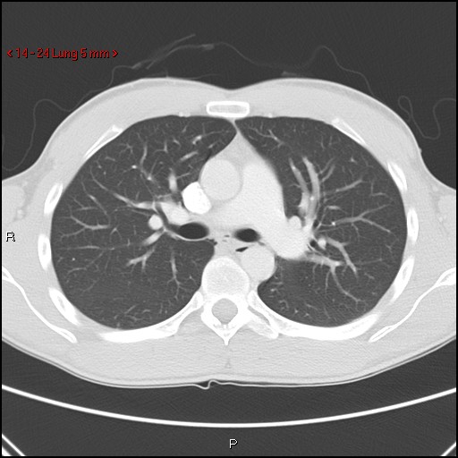 Blunt chest trauma - pulmonary interstitial emphysema and pneumomediastinum (Radiopaedia 20666-20552 Axial lung window 24).jpg