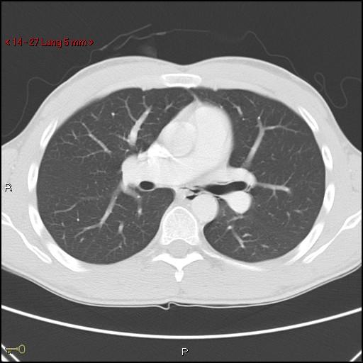 Blunt chest trauma - pulmonary interstitial emphysema and pneumomediastinum (Radiopaedia 20666-20552 Axial lung window 27).jpg