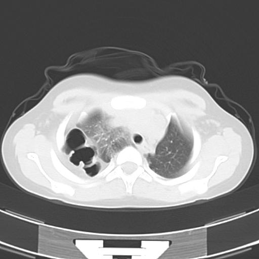 File:Bochdalek diaphragmatic hernia (Radiopaedia 38866-41059 Axial lung window 5).jpg