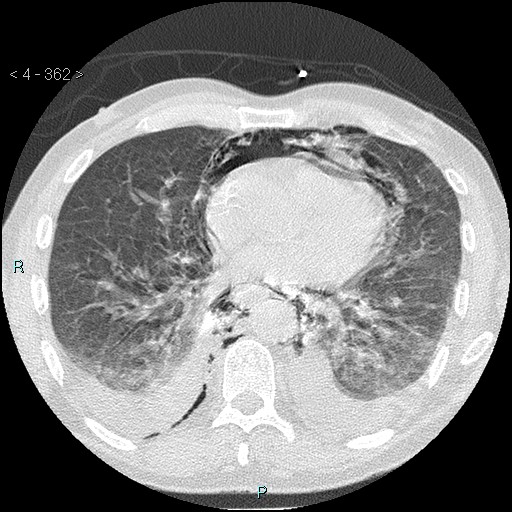 Boerhaave syndrome (Radiopaedia 27683-27897 lung window 62).jpg