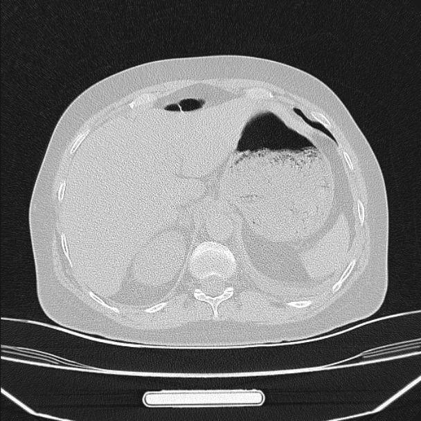 Boerhaave syndrome (Radiopaedia 45644-49799 Axial lung window 102).jpg