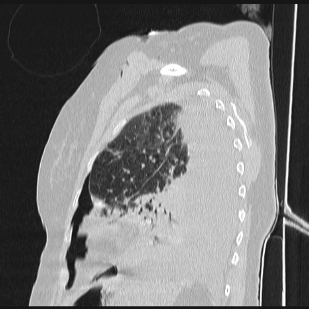 Boerhaave syndrome (Radiopaedia 45644-49799 Sagittal lung window 66).jpg