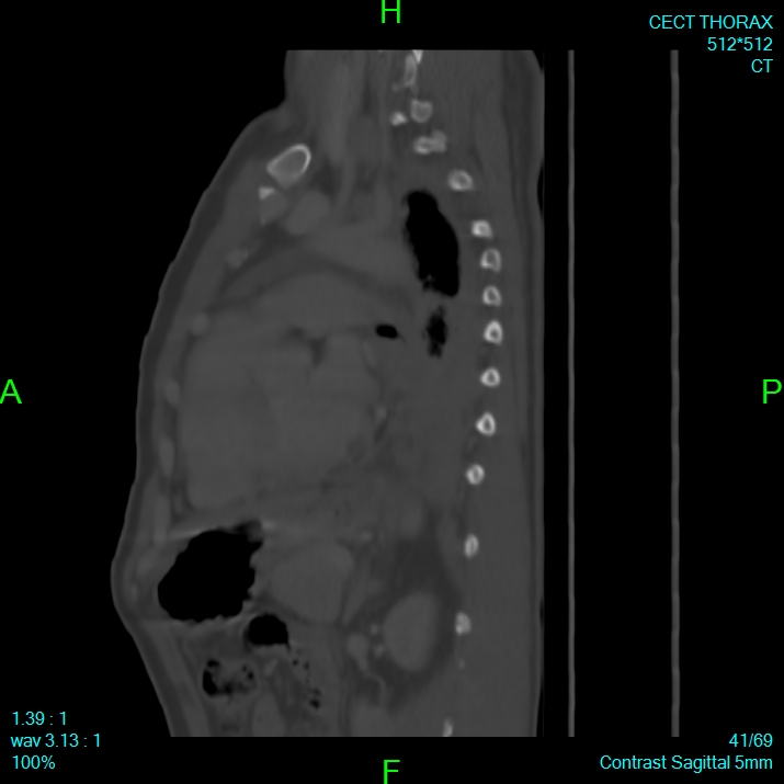 Bone metastases from lung carcinoma (Radiopaedia 54703-60937 Sagittal bone window 41).jpg