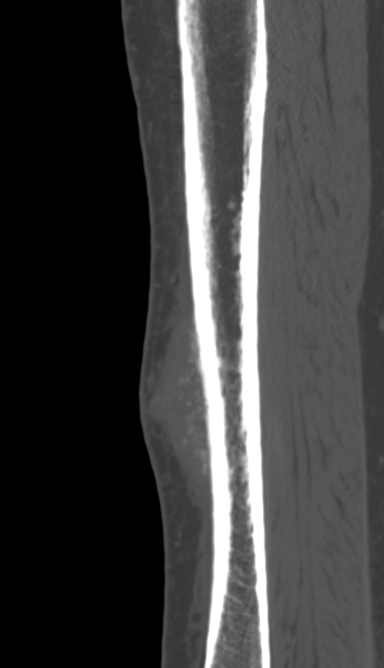 Bone metastasis - tibia (Radiopaedia 57665-64609 Sagittal bone window 64).jpg
