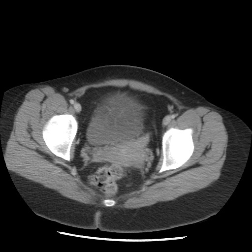 Borderline mucinous tumor (ovary) (Radiopaedia 78228-90808 A 131).jpg