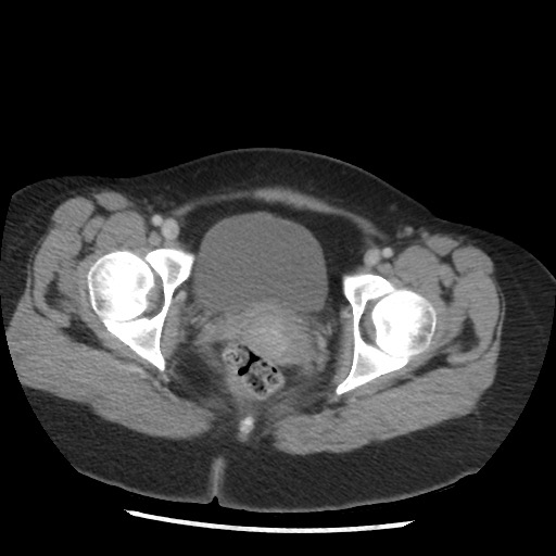 File:Borderline mucinous tumor (ovary) (Radiopaedia 78228-90808 A 134).jpg