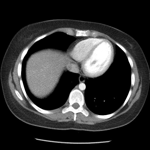 File:Borderline mucinous tumor (ovary) (Radiopaedia 78228-90808 A 34).jpg