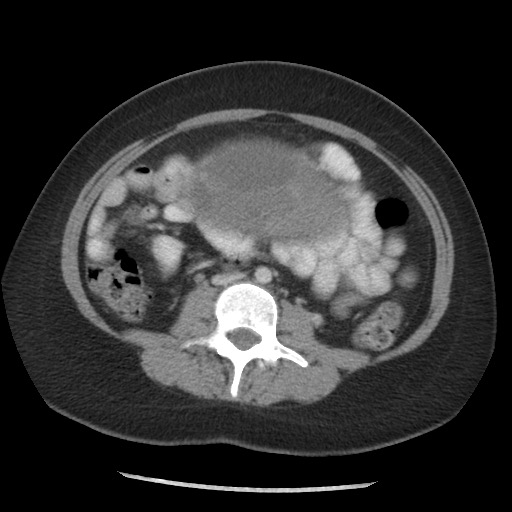 File:Borderline mucinous tumor (ovary) (Radiopaedia 78228-90808 A 94).jpg