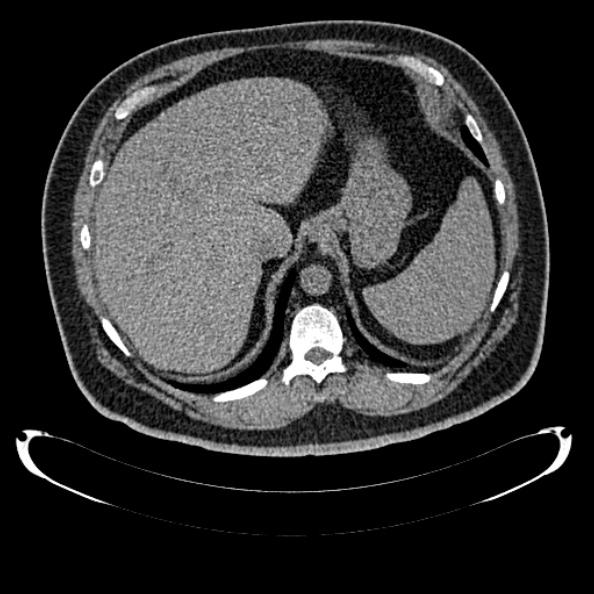Bosniak renal cyst - type IV (Radiopaedia 24244-24518 Axial non-contrast 79).jpg