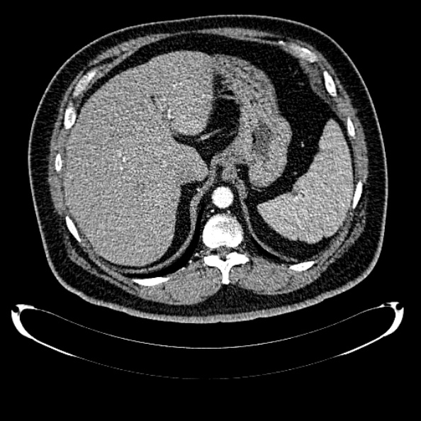 Bosniak renal cyst - type IV (Radiopaedia 24244-24518 B 60).jpg