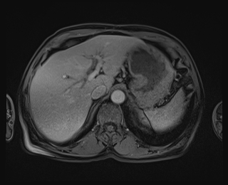 Bouveret syndrome (Radiopaedia 61017-68856 Axial T1 C+ fat sat 20).jpg