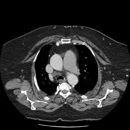 Bovine aortic arch - right internal mammary vein drains into the superior vena cava (Radiopaedia 63296-71875 A 46).jpg