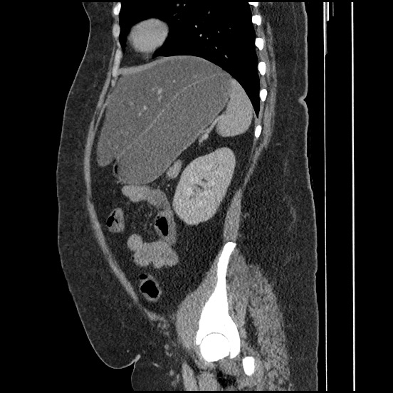 File:Bowel and splenic infarcts in acute lymphocytic leukemia (Radiopaedia 61055-68913 C 28).jpg