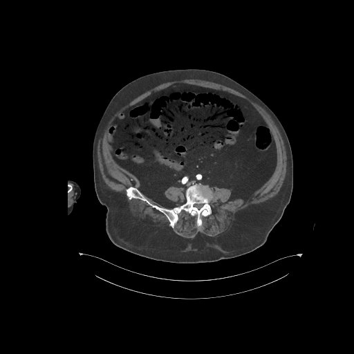 File:Bowel ischemia secondary to SMA occlusion with extensive portomesenteric venous gas (Radiopaedia 54656-60871 A 23).jpg