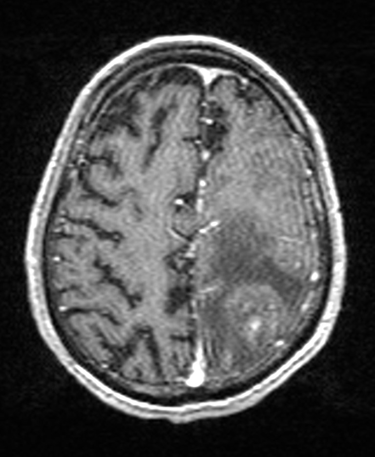 Brain abscess with dual rim sign (Radiopaedia 87566-103938 Axial T1 C+ 123).jpg