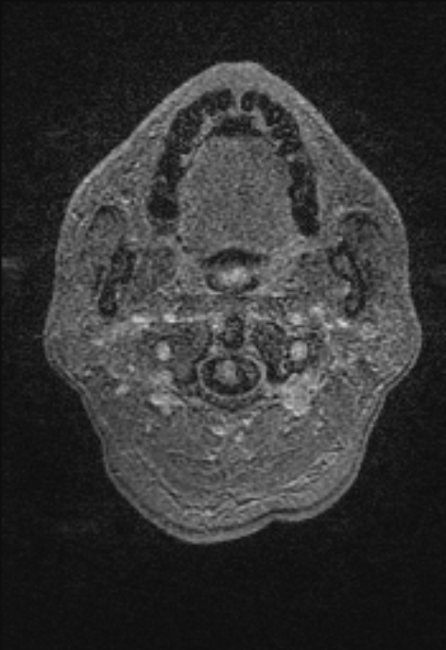 Brain abscess with ventriculitis (Radiopaedia 85703-101495 Axial T1 C+ 1).jpg