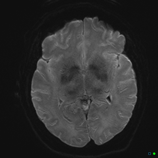 File:Brain death on MRI and CT angiography (Radiopaedia 42560-45689 Axial DWI 12).jpg