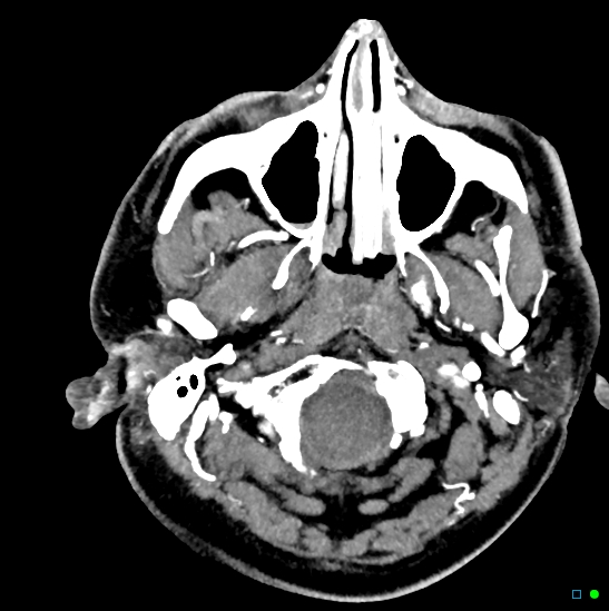 Brain death on MRI and CT angiography (Radiopaedia 42560-45841 B 48).jpg