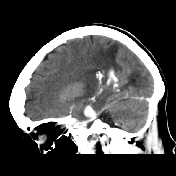 File:Brain metastases from breast cancer (Radiopaedia 23178-23231 C 18).jpg