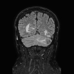 Brain metastases from lung cancer (Radiopaedia 83839-99028 Coronal FLAIR 64).jpg
