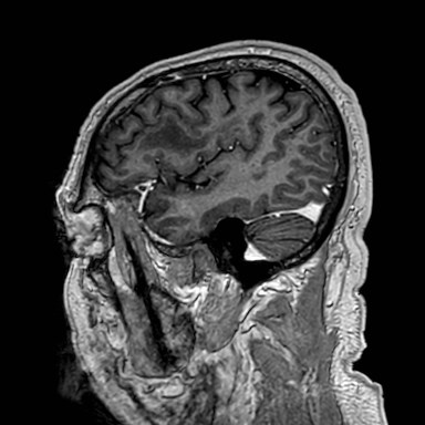 Brain metastases from lung cancer (Radiopaedia 83839-99028 Sagittal T1 C+ 11).jpg
