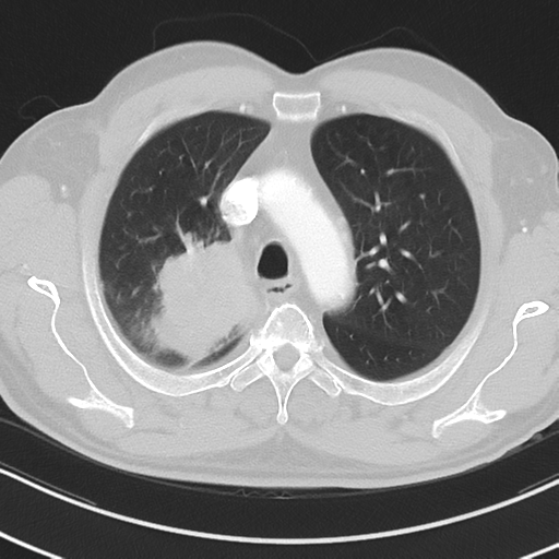 Brain metastasis (large cystic mass) (Radiopaedia 47497-52104 Axial lung window 12).png
