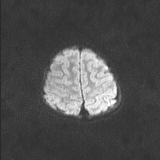 Brainstem glioma (Radiopaedia 67531-76922 Axial DWI 66).jpg