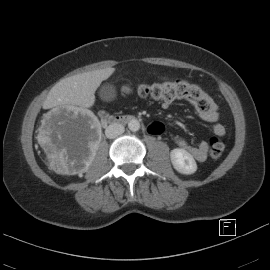 Breast metastases from renal cell cancer (Radiopaedia 79220-92225 C 51).jpg