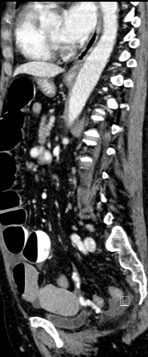 Broad ligament hernia (Radiopaedia 84802-100276 C 31).jpg