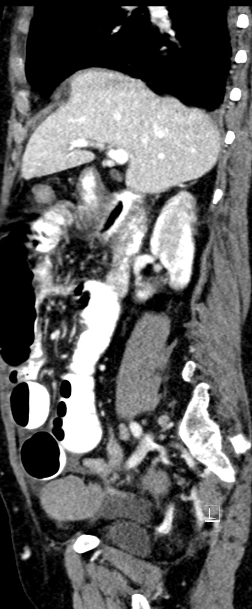 Broad ligament hernia (Radiopaedia 84802-100276 C 52).jpg